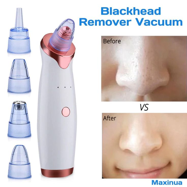 Blackhead Remover