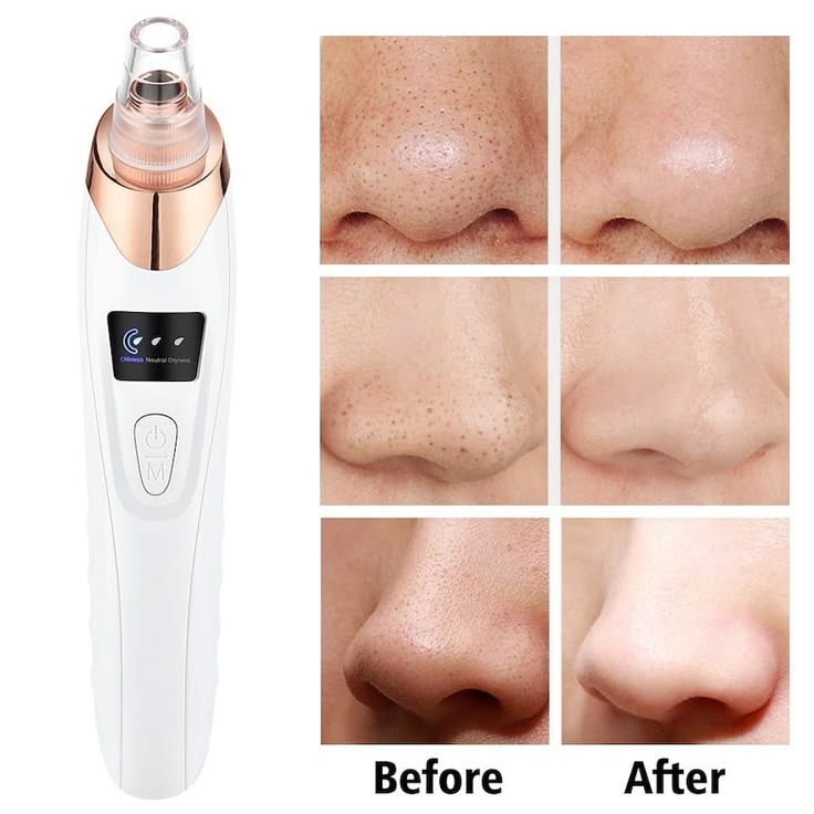Blackhead Remover