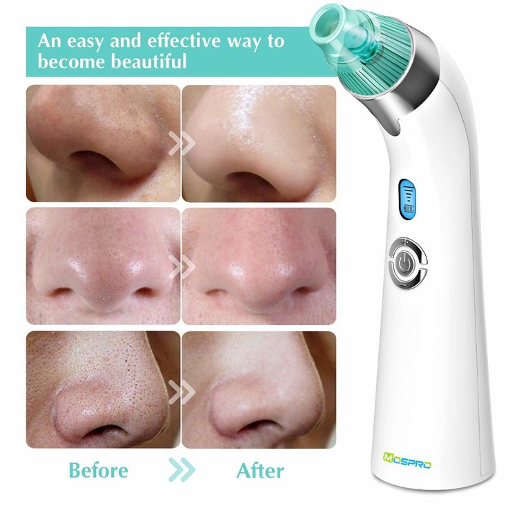 Blackhead Remover